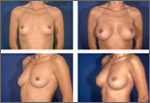 Увеличение груди (эндопротезирование)